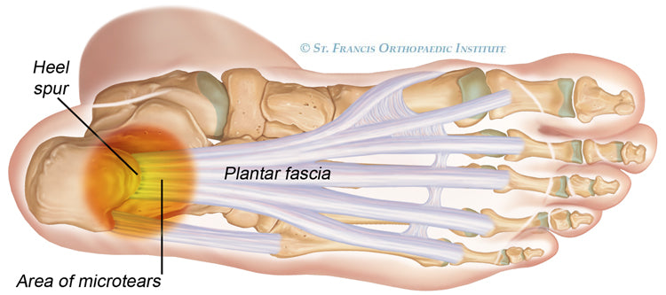 Your Reading Guide to Plantar Fasciitis
